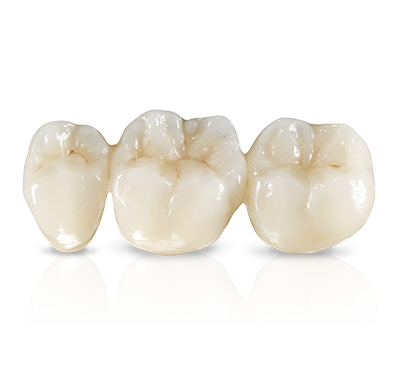 Why Patients Should Choose All Ceramic Restorations Instead Of Pfm Porcelain Fused To Metal Solaris Dental Design